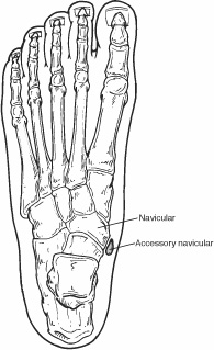 arch support for accessory navicular bone