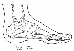 Plantar Fibroma - Foot Health Facts