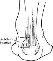 painful lump on achilles tendon