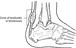 lump on back of heel tendon