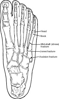 walking after 5th metatarsal fracture