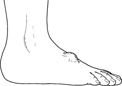 bump under foot