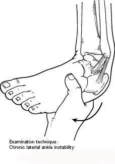 Chronic Ankle Instability – Ankle Sprains
