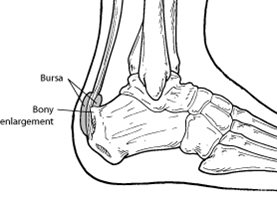 Haglund s Deformity Pump Bump on Heel Foot Health Facts Foot Health Facts