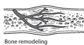 Diagram of bone remodeling during bone healing