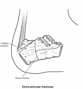 Calcaneal Fracture Heel Bone Fracture Foot Health Facts Foot Health Facts