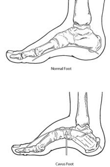 Standard arches high sales foot pressure