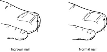 Ingrown toenail and normal toenail