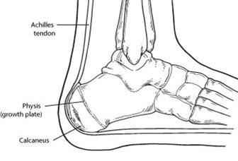 Heel clearance disease child