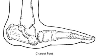 Charcot foot